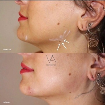 Woman jawline before and after jaw filler treatment