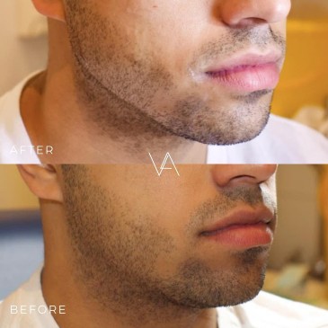 Woman jawline before and after jaw filler treatment