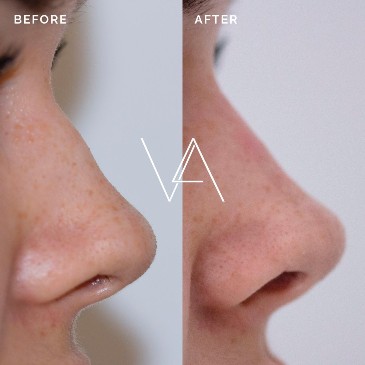 Nose before and after non surgical rhinoplasty