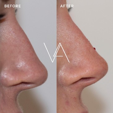 Nose before and after non surgical rhinoplasty