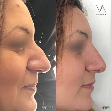 Nose before and after non surgical rhinoplasty